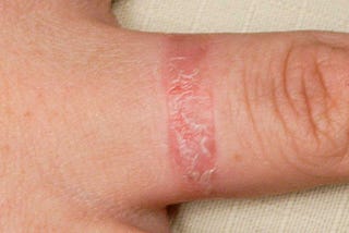 ECZEMA ( ATOPIC DERMATITIS):