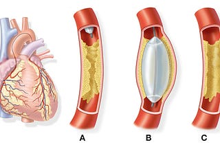 A Closer Look into Rare Cardiac Disorders: Pulmonary Vein Stenosis