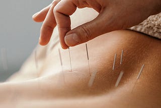 A Healthy Approach to Acupuncture Therapy.