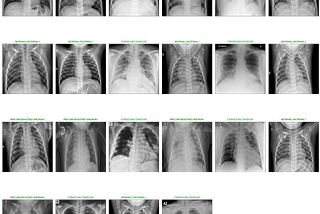 Covid-19 Early Detection from X-ray Images Aided by AI