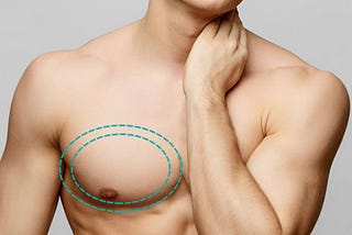 How is Gynecomastia Different from Chest Fat?