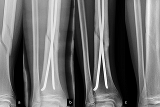 Effects of Weight-Bearing During Foot Fracture Healing