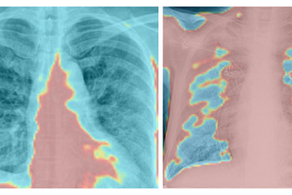 Artificial intelligence for lung disease detection using chest CT scan images