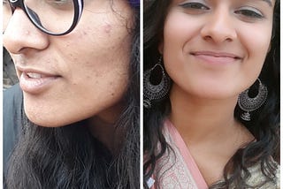 My old picture with acne marks and my current picture