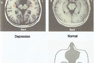 Figure 1: Depression is a Brain Injury. Excerpt from the book “Mental Illness is a Brain Injury” with the permission of the author, Mr. Takumi Tanabe.