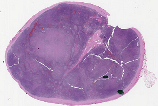 ALK+ ALCL Mimicking CHL