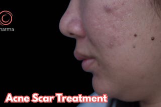Acne Scar Treatment In Bangalore