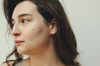 Acne: The Unwanted Guest That Never Leaves