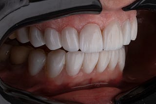 Zirconia Crowns for Anterior Teeth: The Perfect Solution for a Dazzling Smile