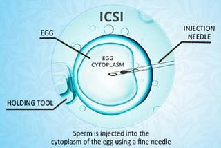 How ICSI Treatment in Delhi Revolutionizes Fertility Solutions