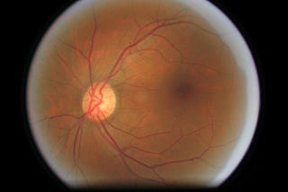 Diabetic Retinopathy Detection with ResNet50