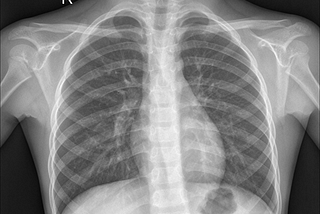 Chest X-ray Pneumonia Detection with Neural Networks