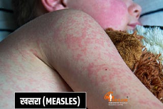 Measles ka treatment in hindi