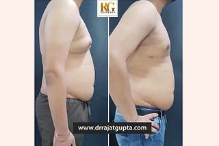 Common Side Effects and Risks of Gynecomastia Surgery