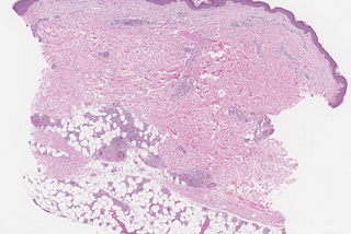 Intravascular Large B-Cell Lymphoma