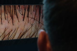 A man viewed from behind looking at a monitor that shows a magnified trichoscopy image of his scalp and hair follicles.
