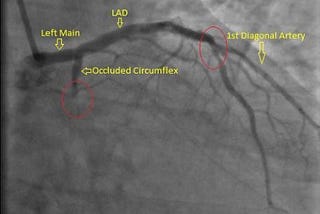 Heart Attack in a Healthy 34-Year Old With Elevated Lipoprotein(a) Cholesterol