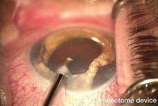 Complex Cases, Simplified (8): Trabectome — Helping to reduce IOP on a wide patient spectrum