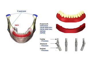 Titanium Complete-arch Fixed Implant-supported Frameworks