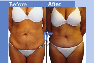 Get a Tummy Tuck Surgery and Say Goodbye to Your Belly Bulge