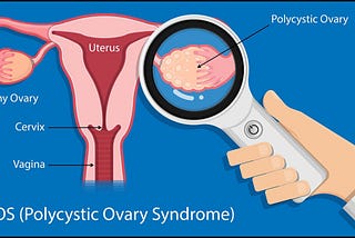 Polycystic Ovarian Syndrome Treatment