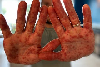 Hand Foot and Mouth Disease in Adults.