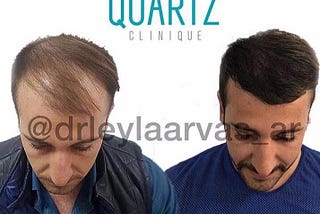 10 questions and 10 answers about Hair Transplantation in Istanbul!!!