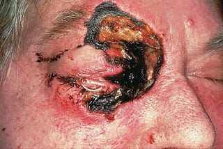Click the link to know about Mucormycosis- the ‘black fungus’