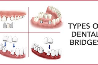 Dental bridges Types & Process | Dental advice online in delhi