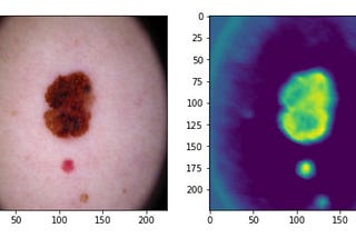 Skin Cancer Image Classification — An Educational Guide