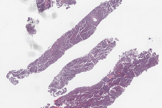 Benign Inflamatory Lymphadenopathy (EBV-Negative Infectious Mononucleosis-Like Lymphoproliferative…