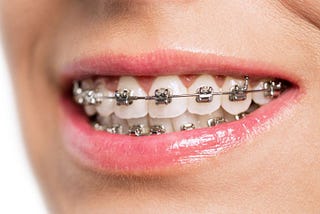 metal braces in HOMEWOOD, IL