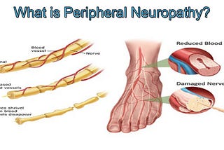 Dr. Tad Tenney | What is Peripheral Neuropathy?