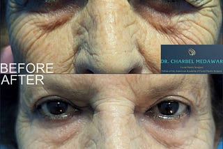 Dr Charbel Medawar Talks About What to Expect After Blepharoplasty Surgery