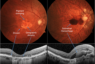 Ayurvedic Treatment for Macular Degeneration