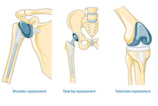 Navigating Health Data Analysis: My Experience in Hip and Knee Arthroplasty