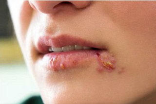 Herpes genitalis — Symptoms, causes, and treatment