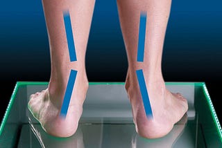 5 Easy Steps For Flat Feet Overpronation Treatment