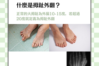 拇趾外翻 Hallux Valgus