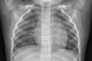 X-Ray Image Classification: The Easy Way