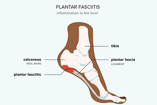 Effective Plantar Fasciitis Relief: Best Exercises and Insoles for Foot Pain Management