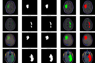 Brain Tumor classification and detection from MRI images using CNN based on ResU-Net Architecture