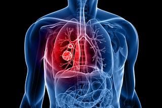 Are there any ongoing clinical trials for experimental lung cancer treatments in Gurgaon?