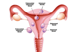 Uterine Fibroids: spreading awareness