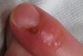 Secrets of Herpes on Finger No One
Has Ever Told You