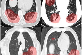 COVID-NET CT-2: An Evolutionary Leap