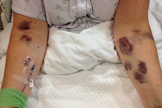 What I learned about COVID-19 from Acute Myeloid Leukemia