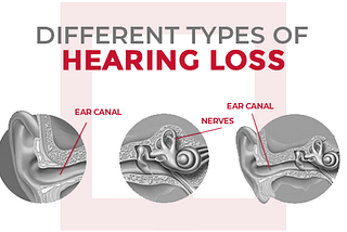 Hearing loss in Adults- Types, Causes and Treatments