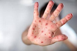 Hand, Foot, and Mouth Disease