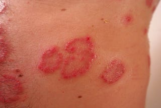 8 Tips For Psoriasis Care: Beginners Guide